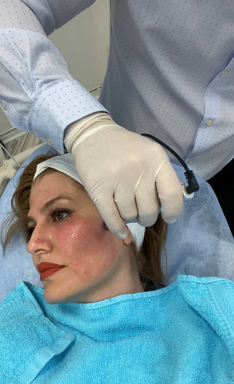 Microneedling i Göteborg