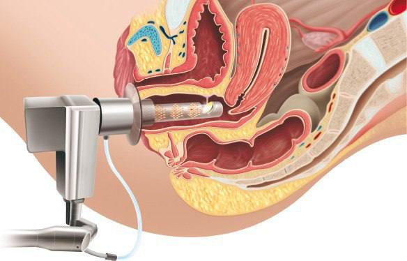 fraktionerad CO2-laser för vaginal föryngring