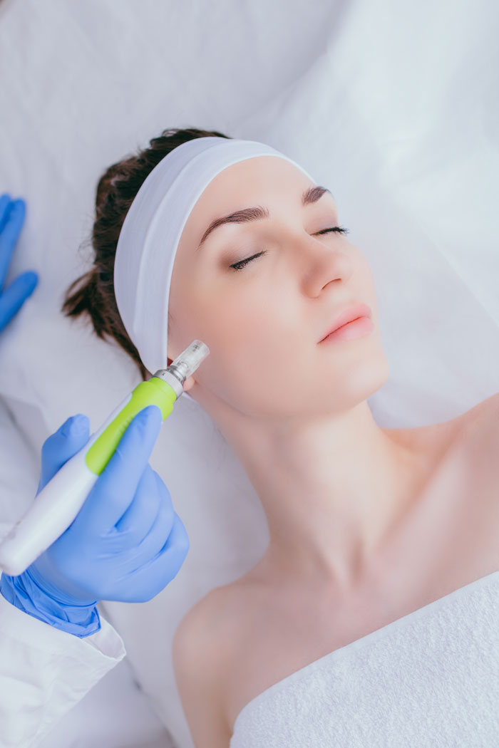 MICRO-NEEDLING-i-Göteborg MICRO NEEDLING