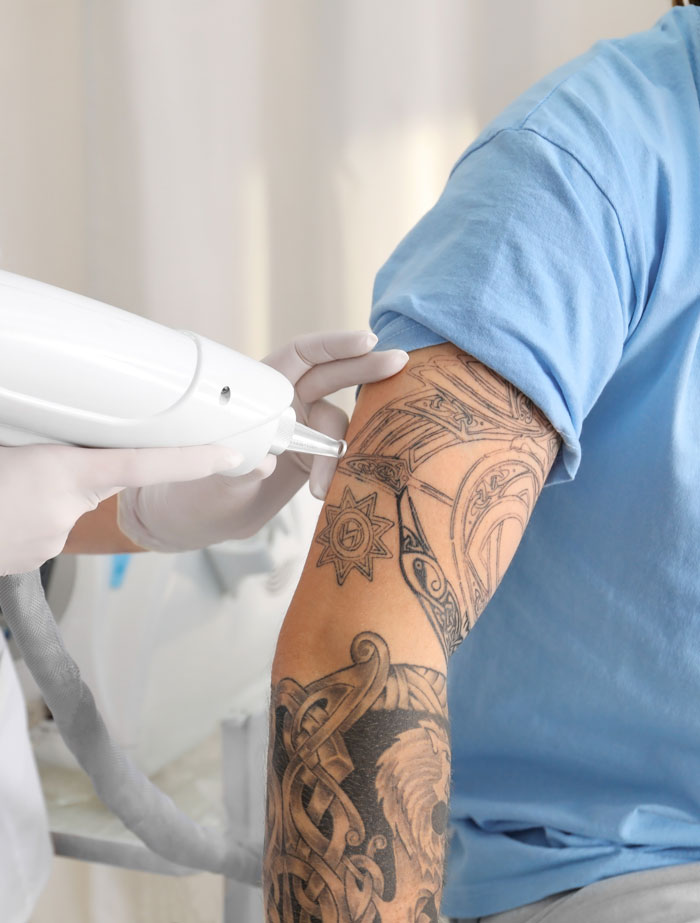 Tatueringsborttagning med Q switch Nd Yag laser i Ambers Laserklinik