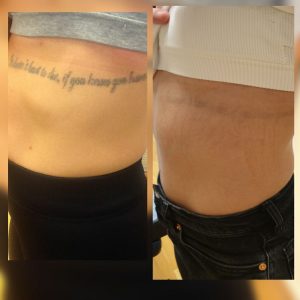 tatueringsborttagning göteborg