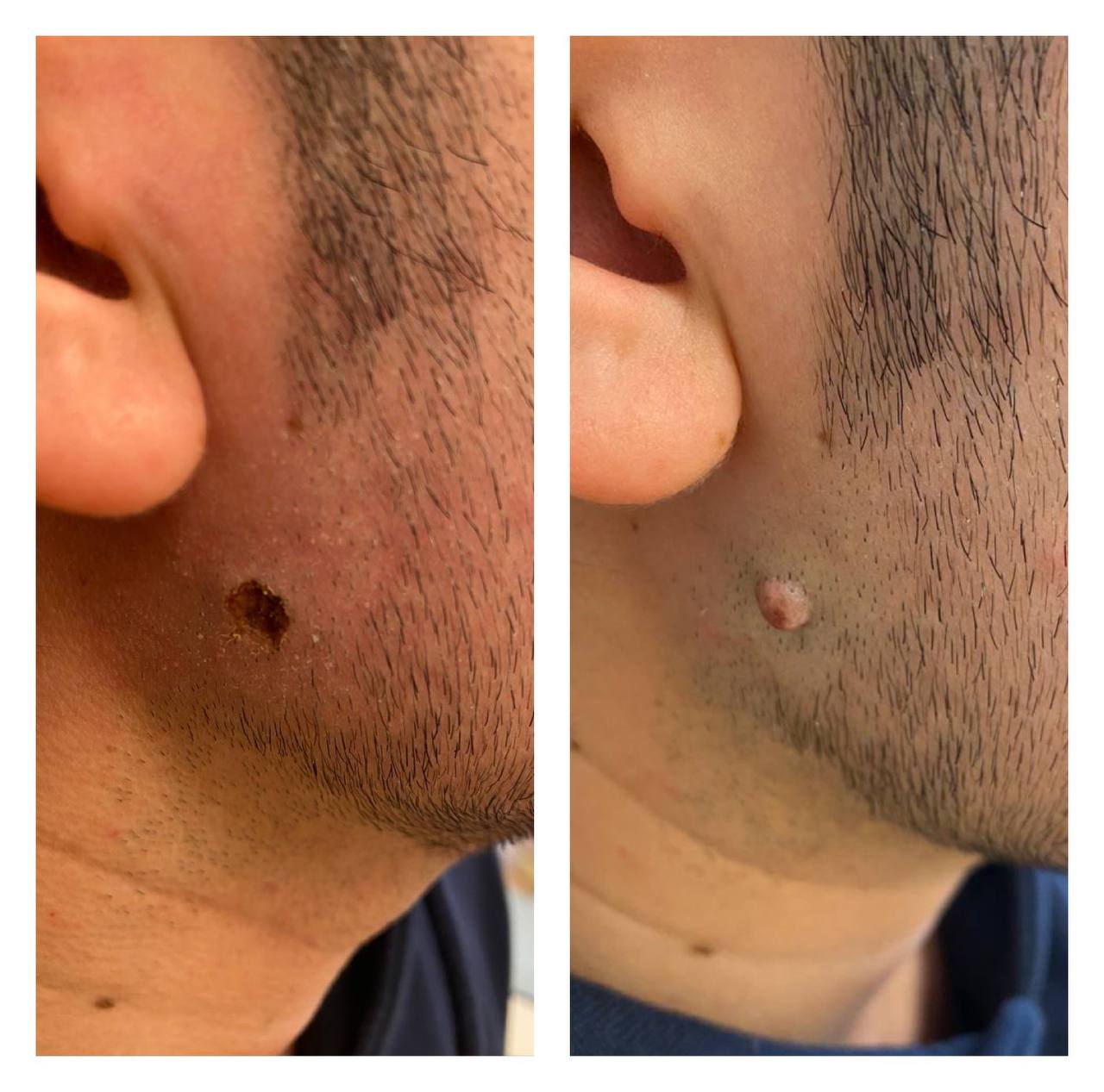 mole removal