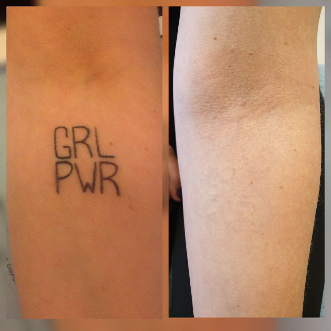 detta bild visar före och efter tatueringsborttagning